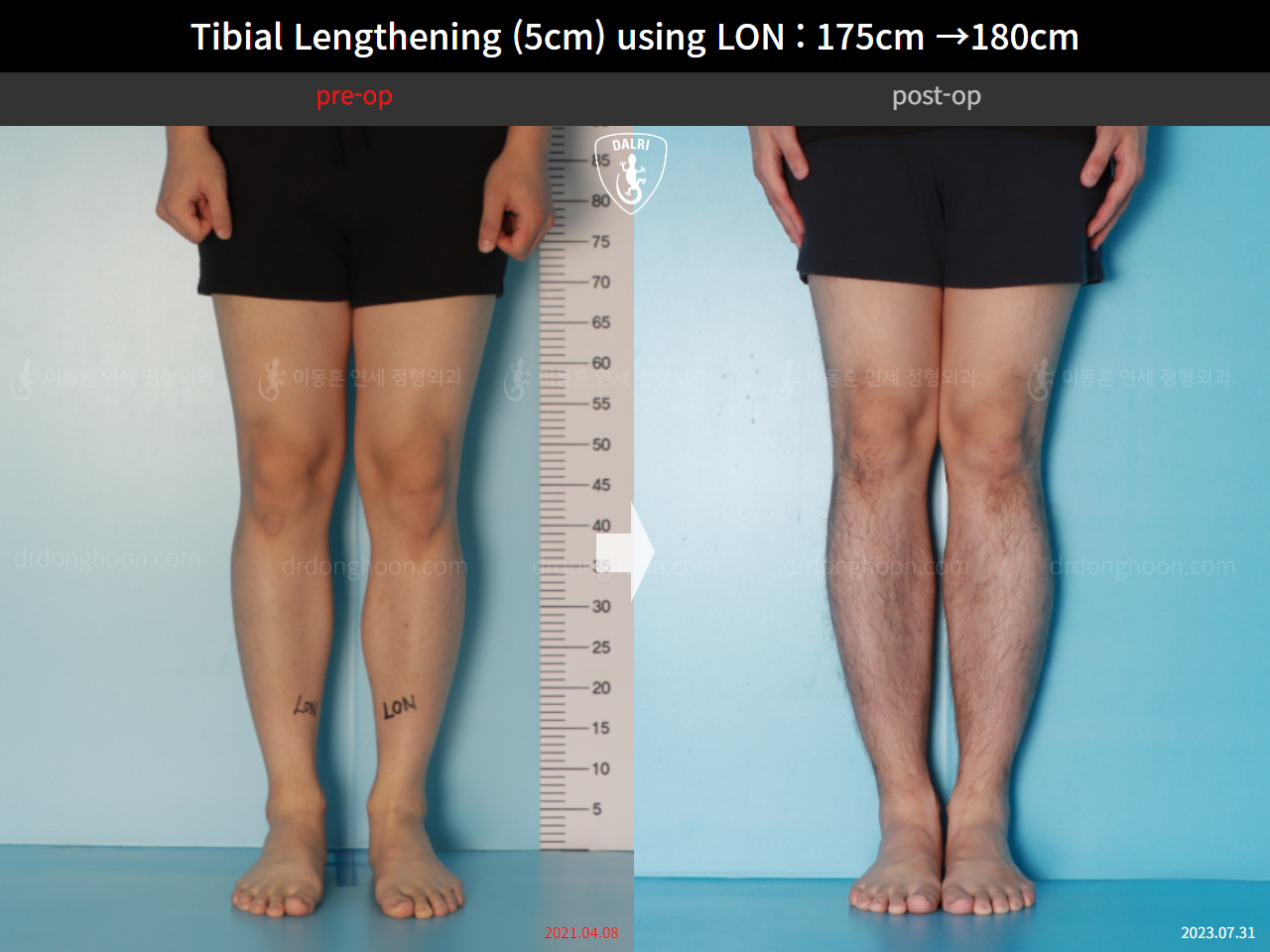 Before and after cll lon, case 15931051, image 5, Dr. Donghoon institute (DALRI)