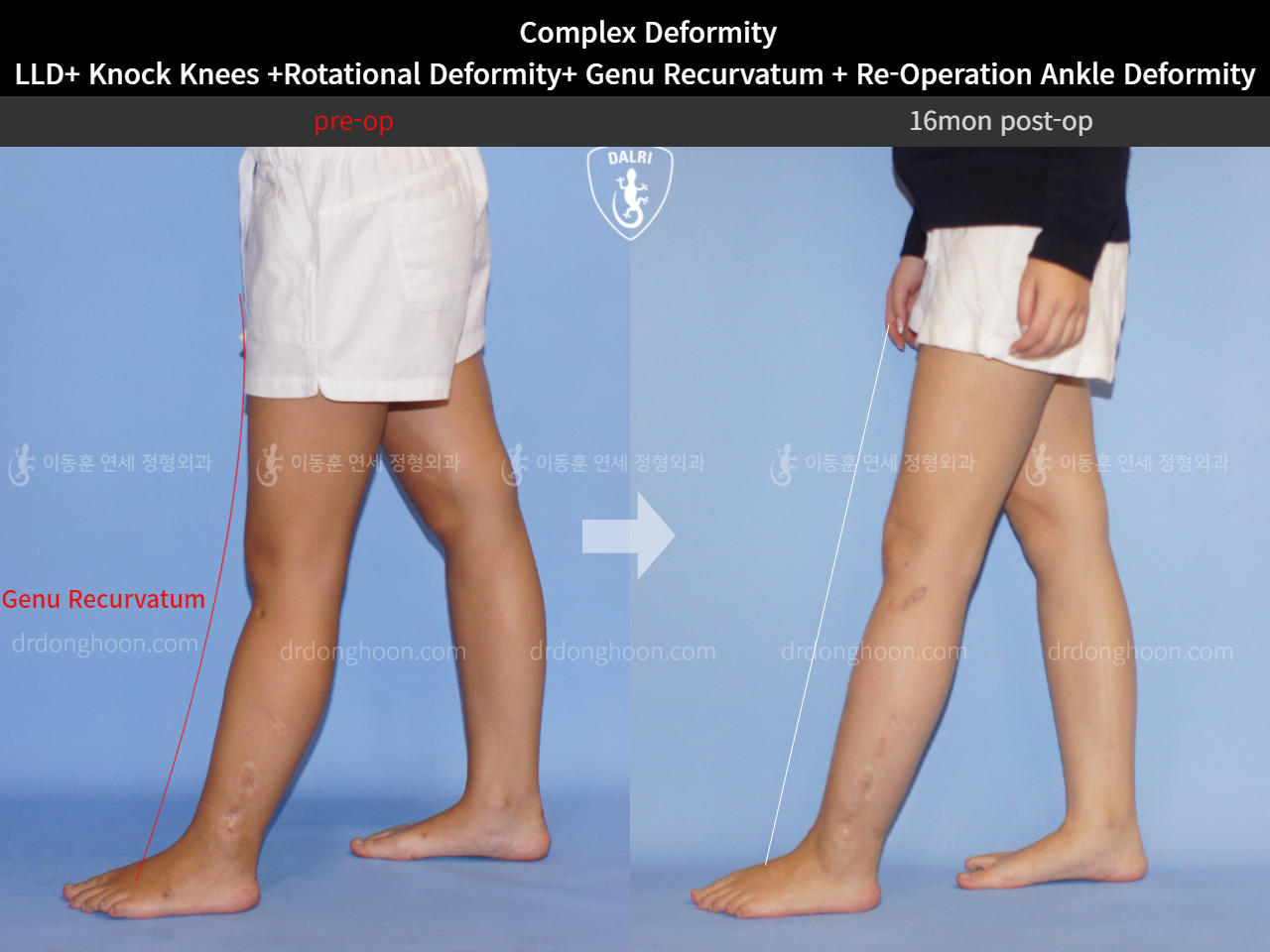 Before and after adult lld, case 5301879, image 6, Dr. Donghoon institute (DALRI)