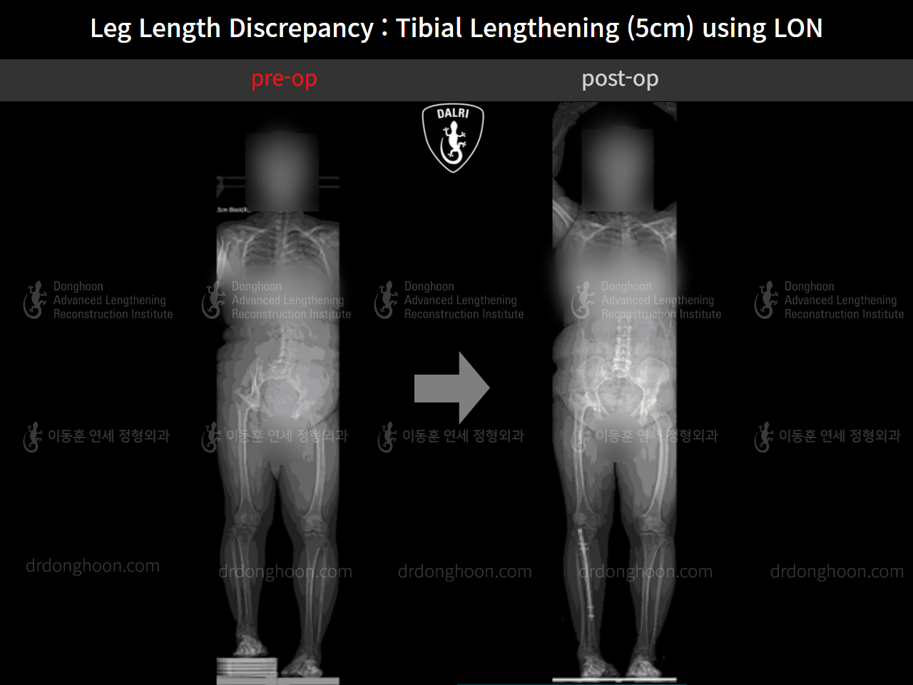 Before and after adult lld, case 9974673, image 7, Dr. Donghoon institute (DALRI)