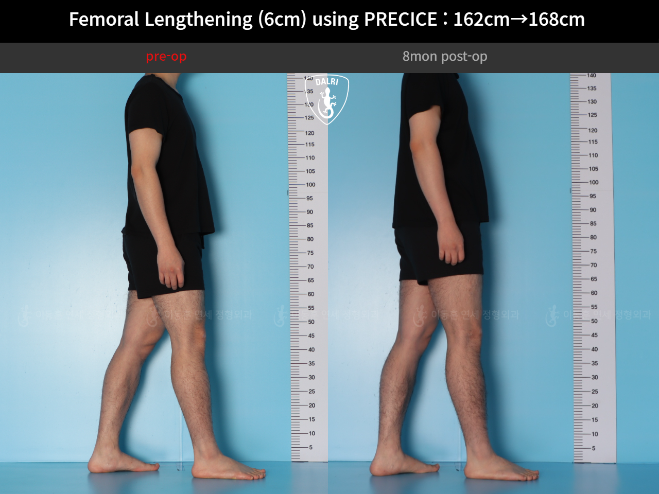 Before and after cll precice, case 52565195, image 5, Dr. Donghoon institute (DALRI)