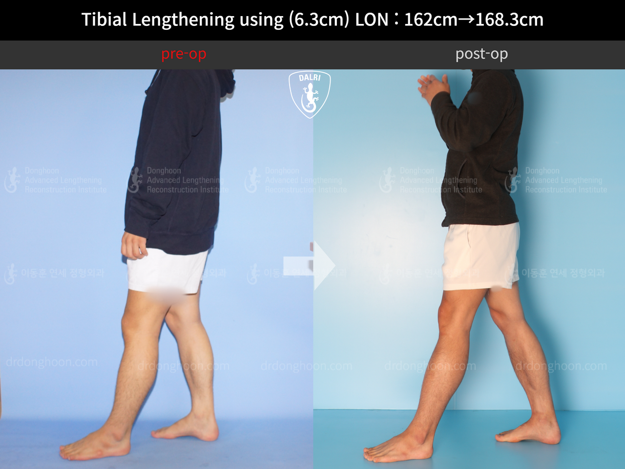 Before and after cll lon, case 12817675, image 3, Dr. Donghoon institute (DALRI)