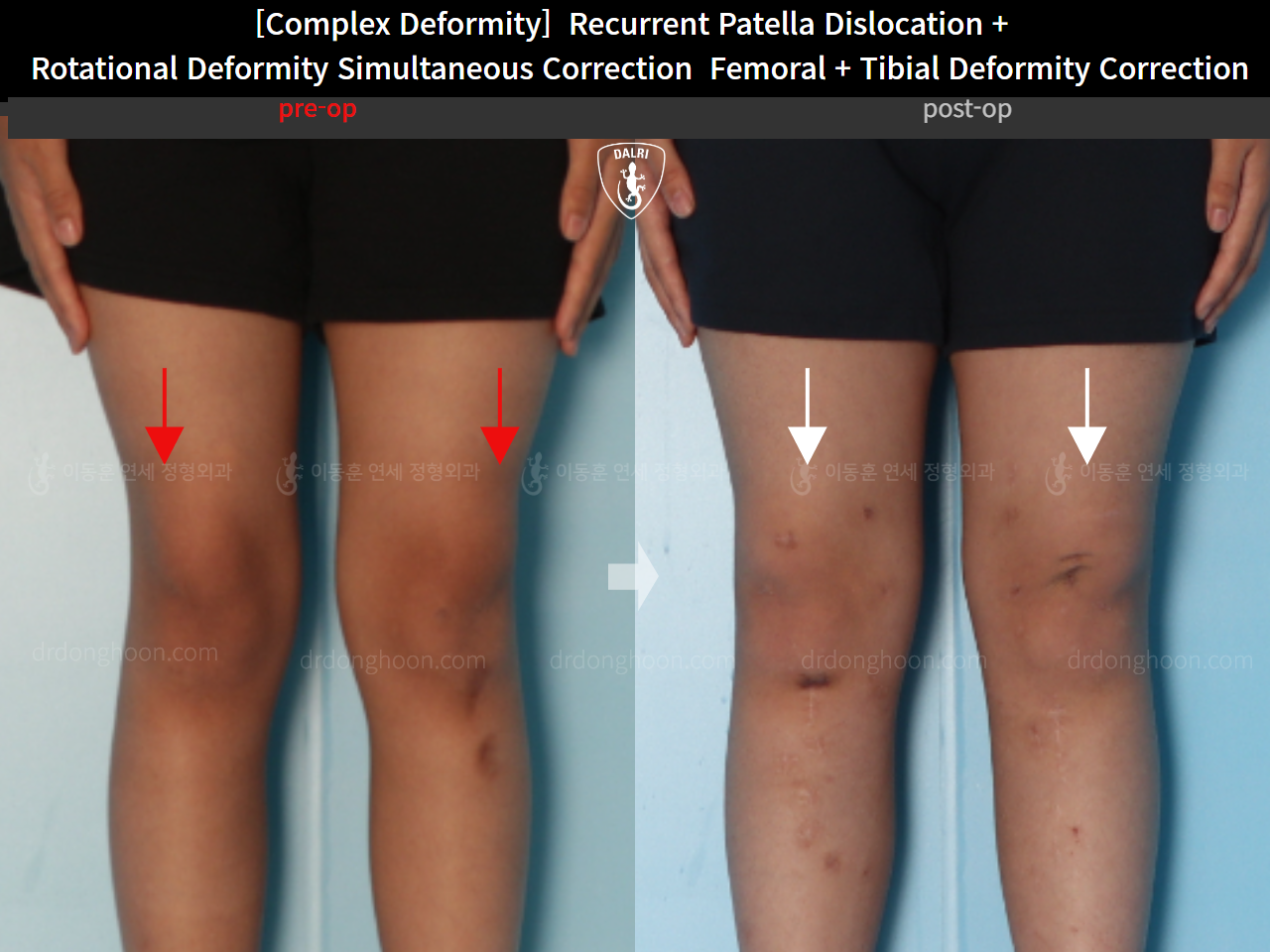 Before and after complex deformity, case 16298867, image 6, Dr. Donghoon institute (DALRI)