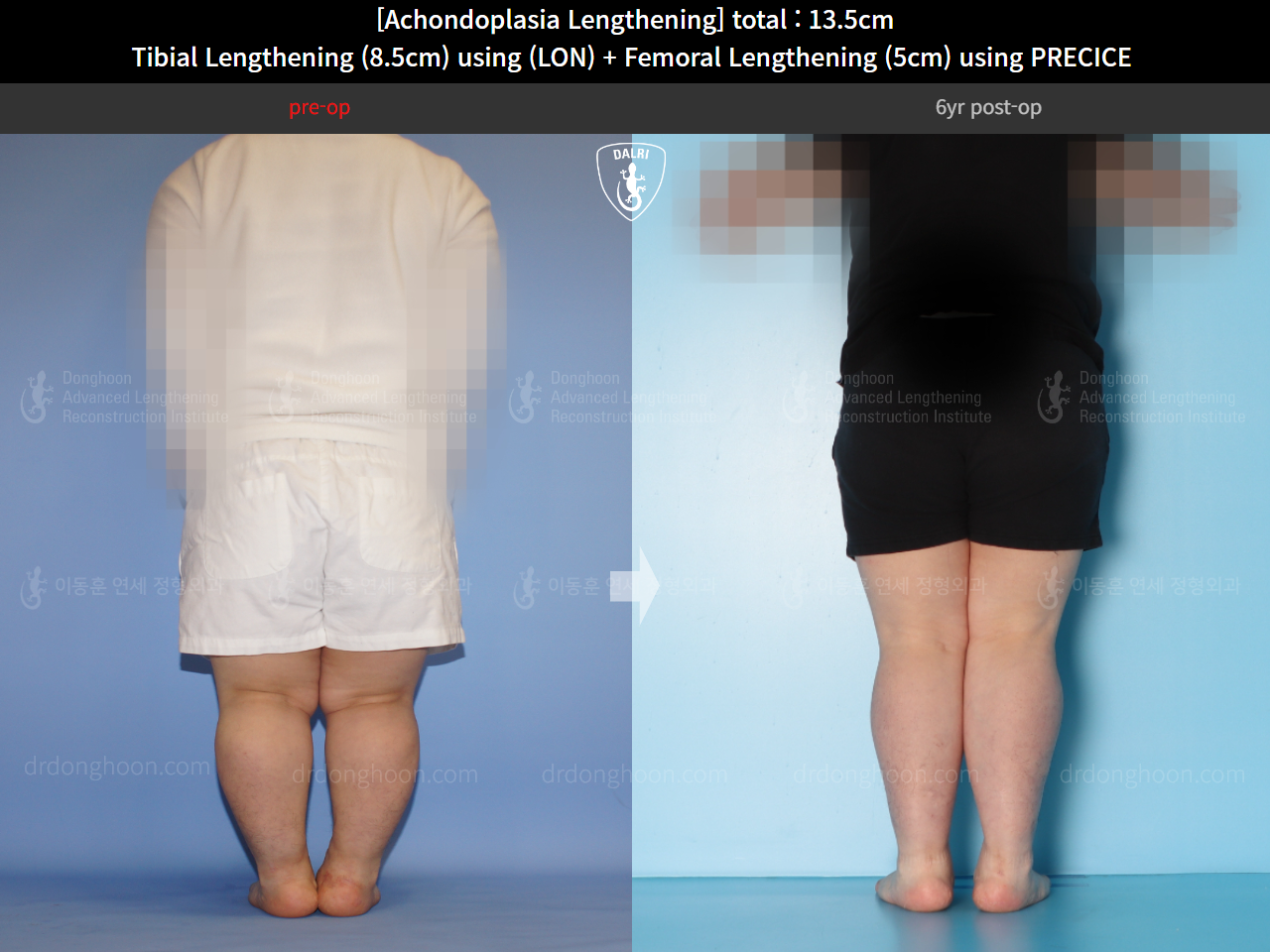 Before and after congenital condition, case 14993507, image 6, Dr. Donghoon institute (DALRI)