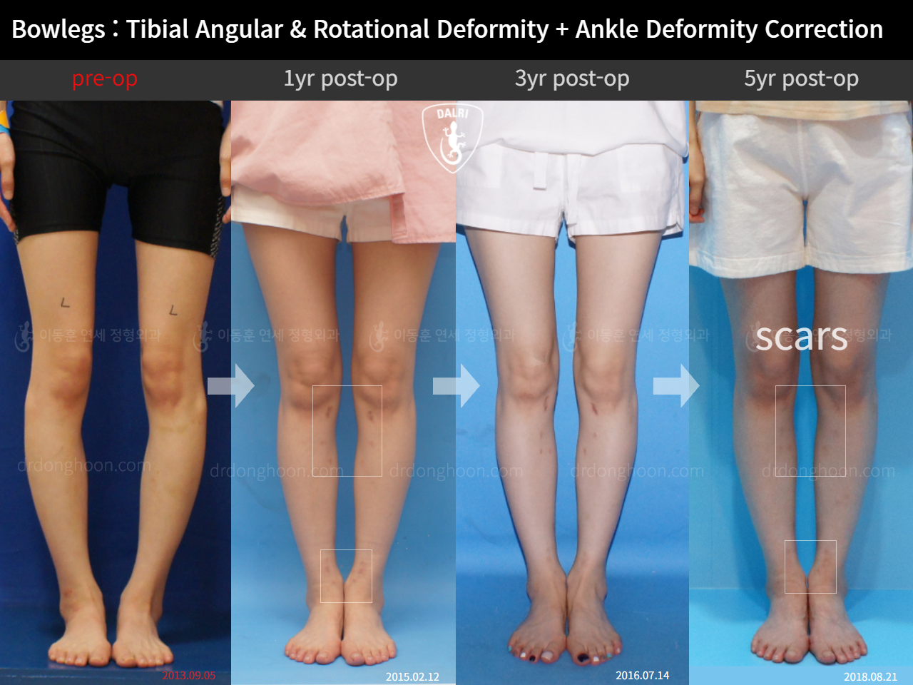 Before and after complex deformity, case 9471622, image 4, Dr. Donghoon institute (DALRI)
