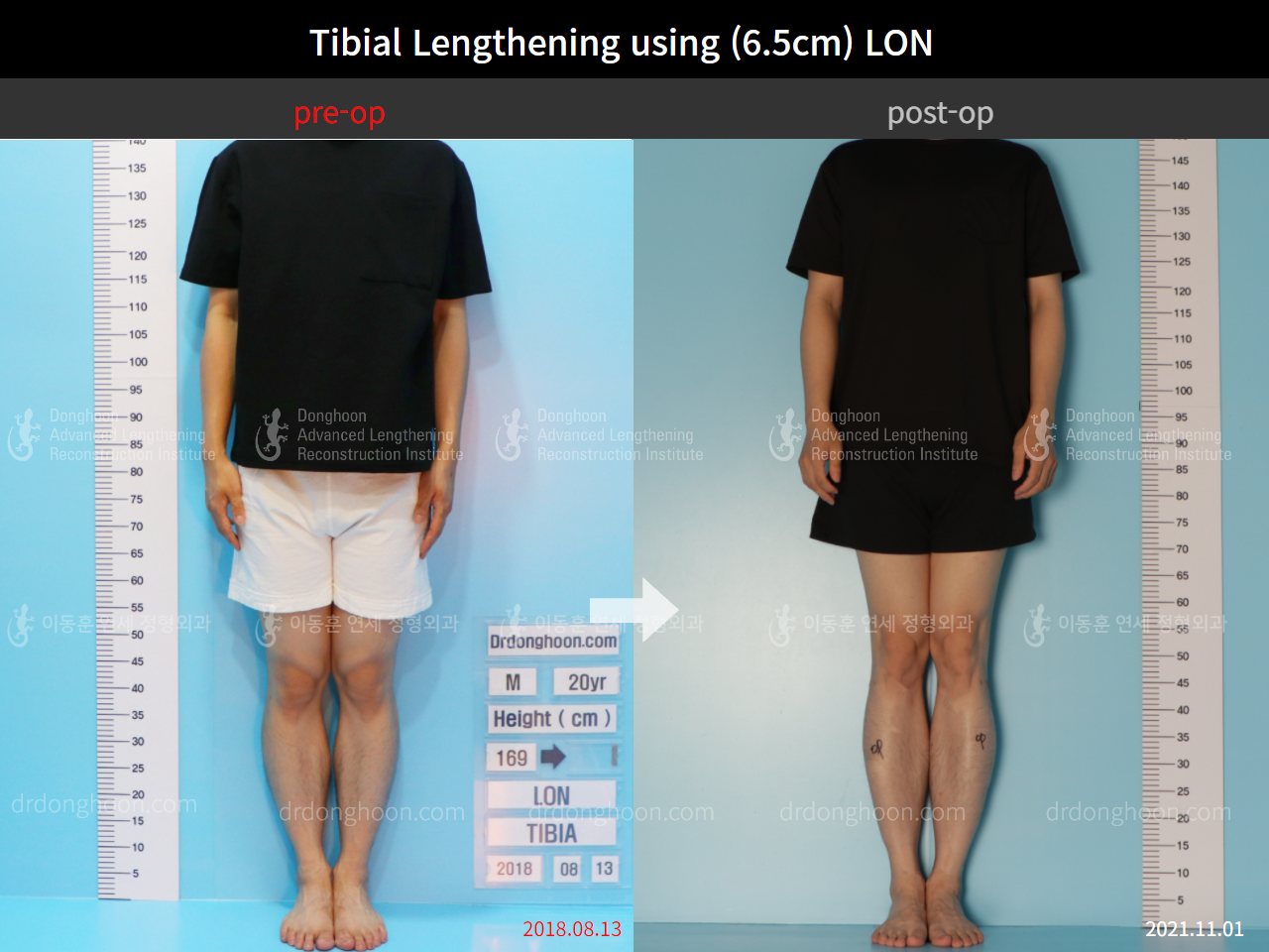 Before and after cll lon, case 8777040, image 1, Dr. Donghoon institute (DALRI)