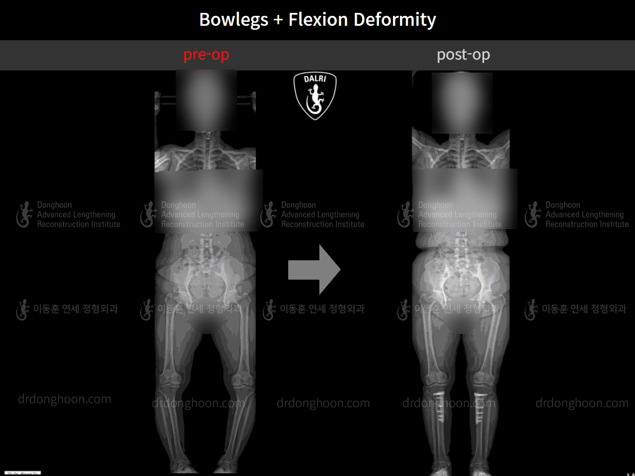 Before and after osteotomy for knee osteoarthritis, case 4586352, image 7, Dr. Donghoon institute (DALRI)