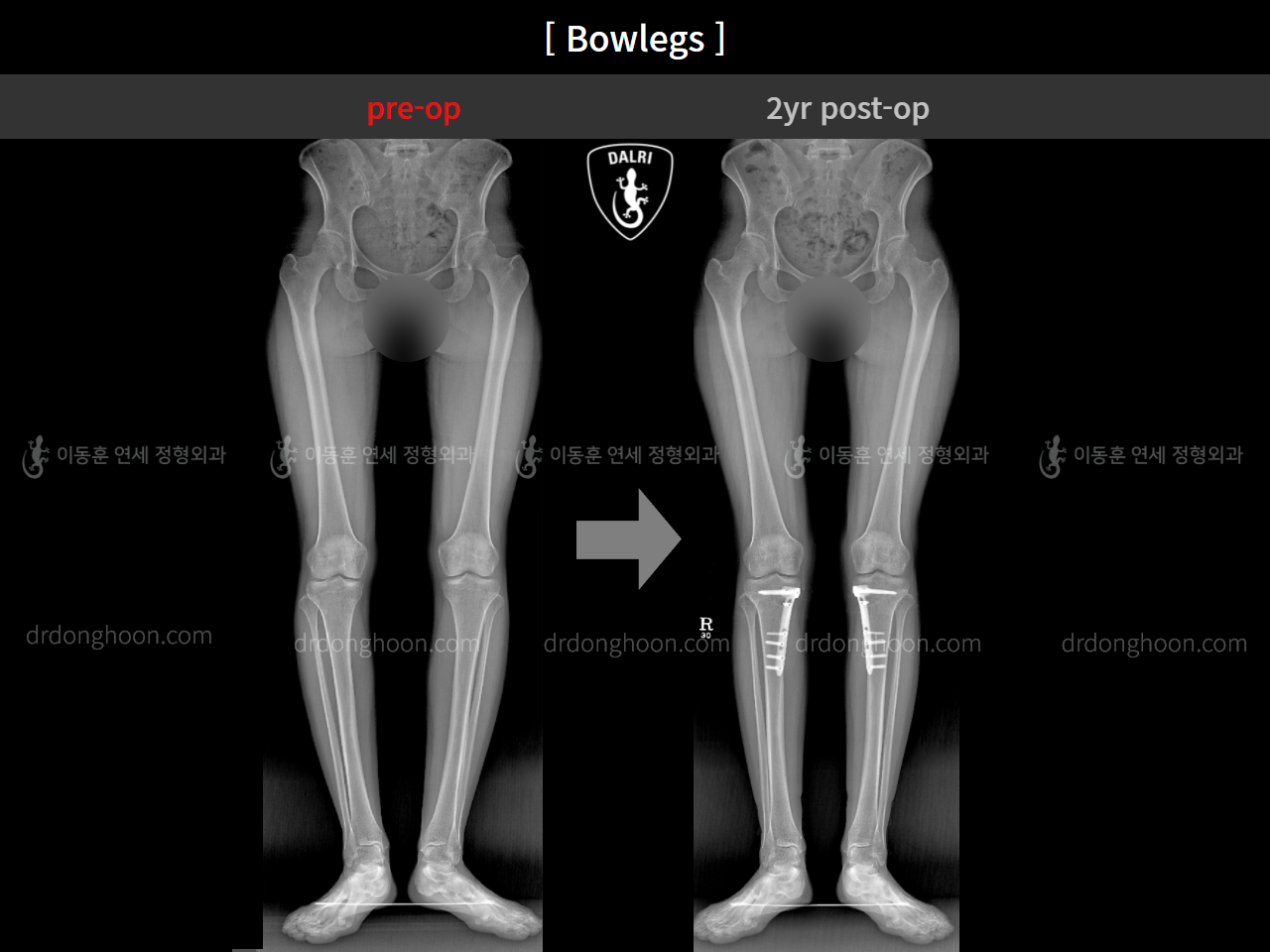 Before and after adult bowlegs, case 4311371, image 7, Dr. Donghoon institute (DALRI)