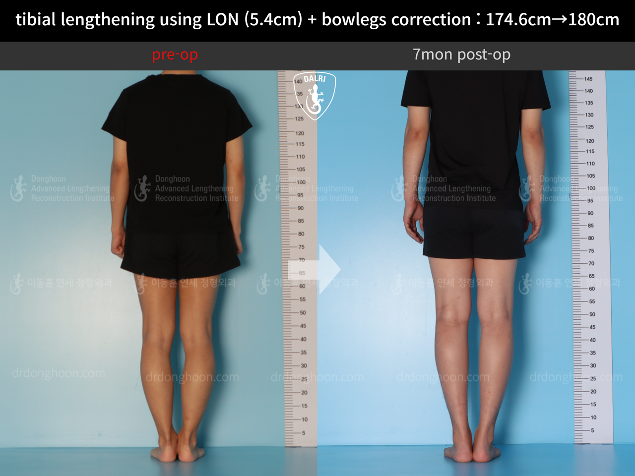 Before and after cll + deformity correction, case 12718558, image 3, Dr. Donghoon institute (DALRI)