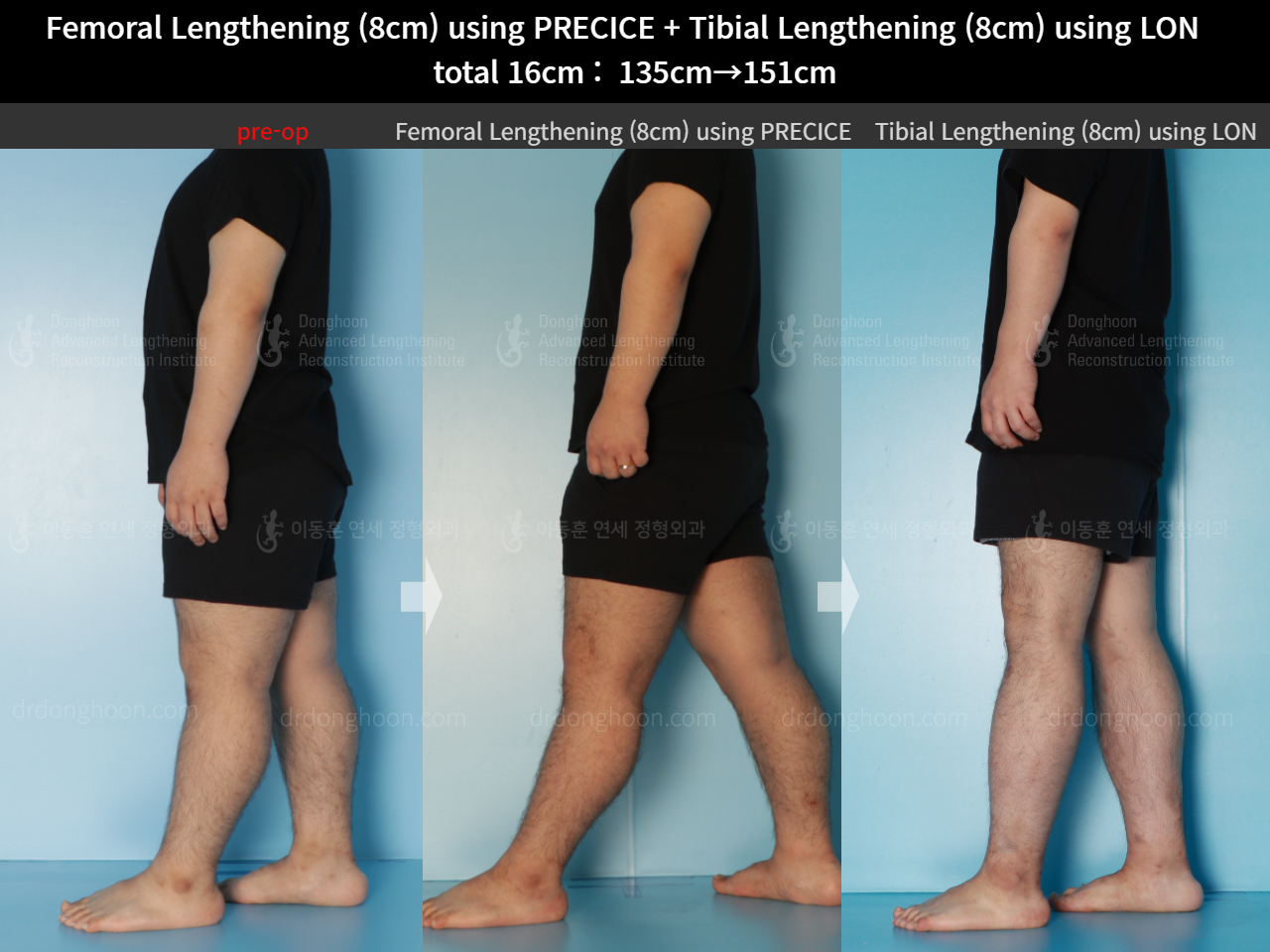 Before and after cll lon, case 16524730, image 3, Dr. Donghoon institute (DALRI)