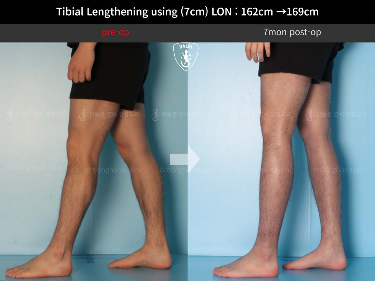 Before and after cll lon, case 13743472, image 12, Dr. Donghoon institute (DALRI)