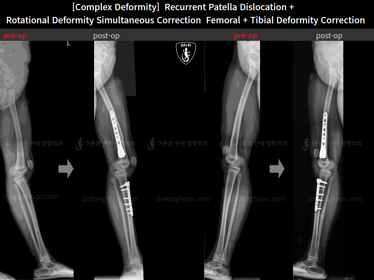 Before and after complex deformity, case 16298867, image 11, Dr. Donghoon institute (DALRI)