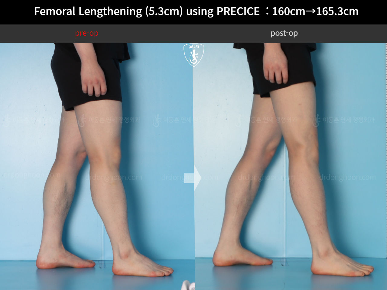 Before and after cll precice, case 18250566, image 9, Dr. Donghoon institute (DALRI)
