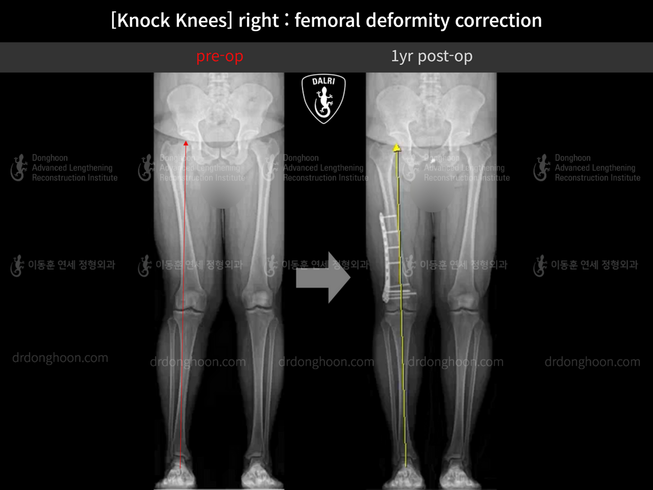 Before and after adult knock knees, case 13582115, image 7, Dr. Donghoon institute (DALRI)