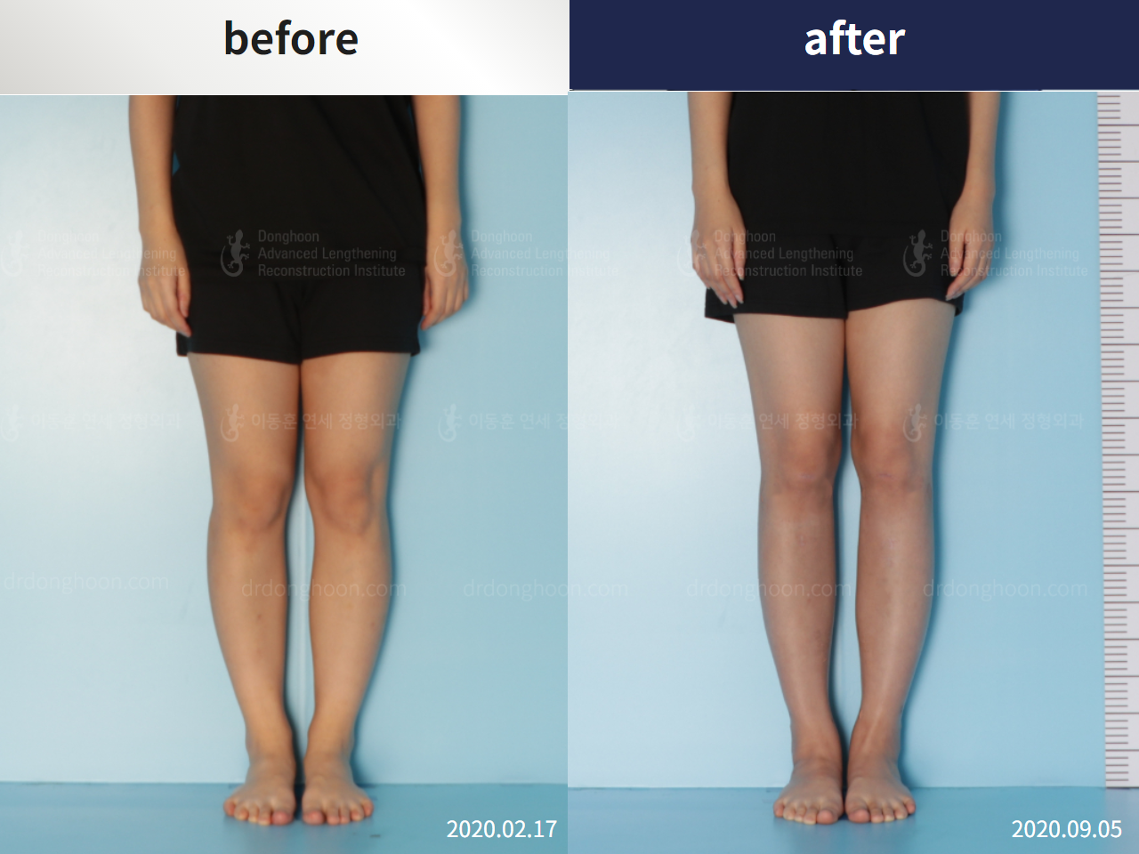 Before and after cll lon, case 4860839, image 1, Dr. Donghoon institute (DALRI)