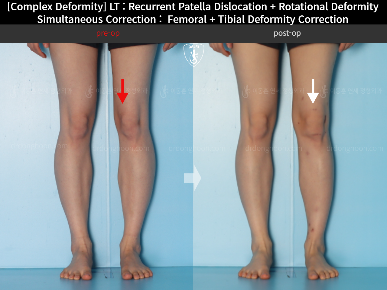 Before and after adult bowlegs, case 18088212, image 4, Dr. Donghoon institute (DALRI)
