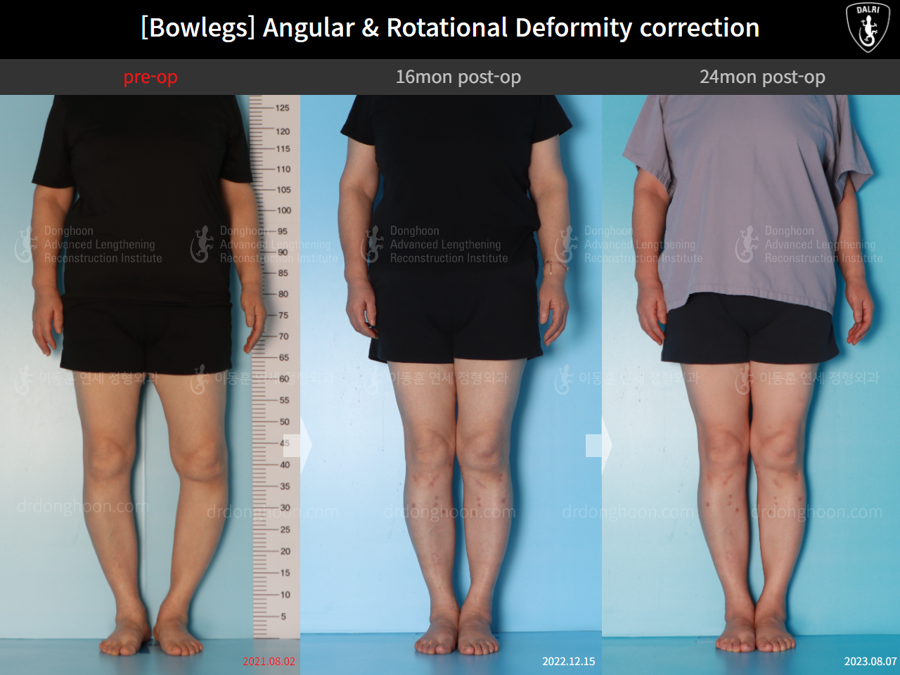 Before and after osteotomy for knee osteoarthritis, case 16074487, image 1, Dr. Donghoon institute (DALRI)