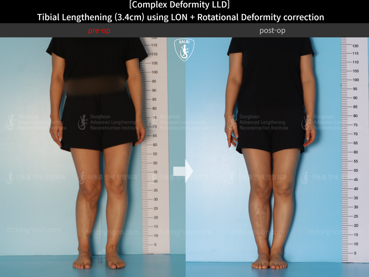 Before and after adult lld, case 14350311, image 2, Dr. Donghoon institute (DALRI)