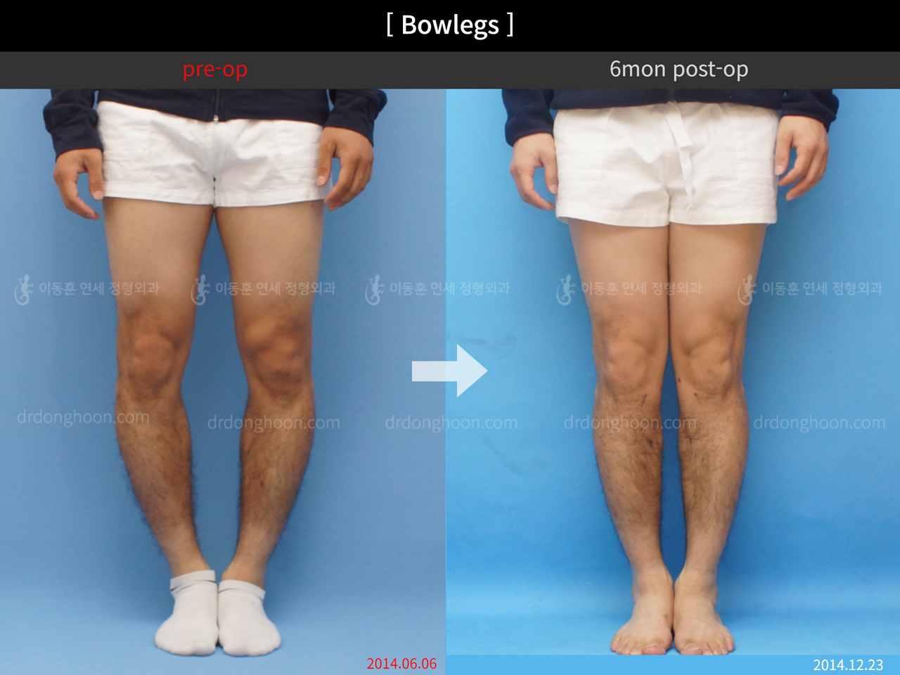 Before and after adult bowlegs, case 4311354, image 3, Dr. Donghoon institute (DALRI)