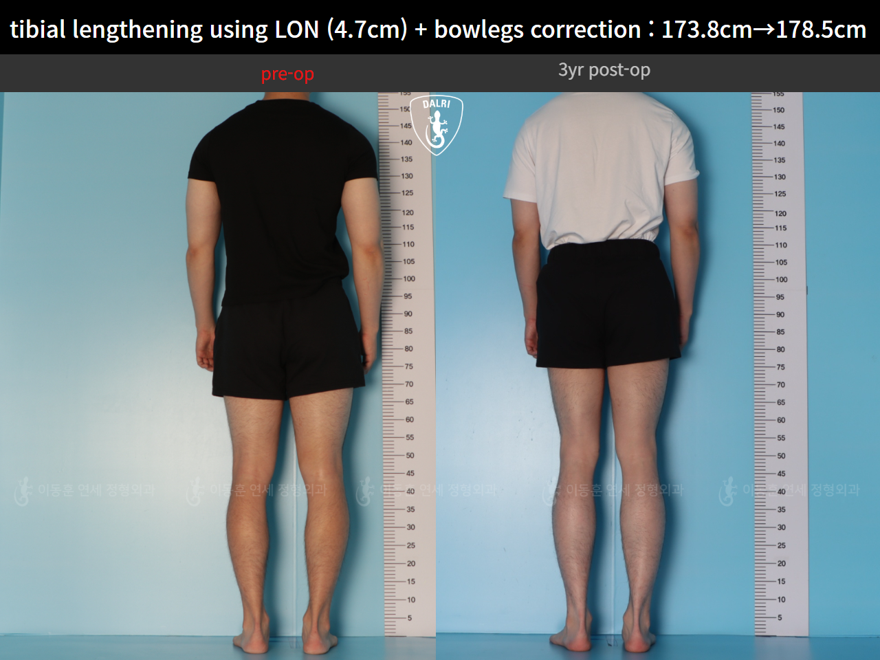 Before and after cll + deformity correction, case 128582896, image 4, Dr. Donghoon institute (DALRI)