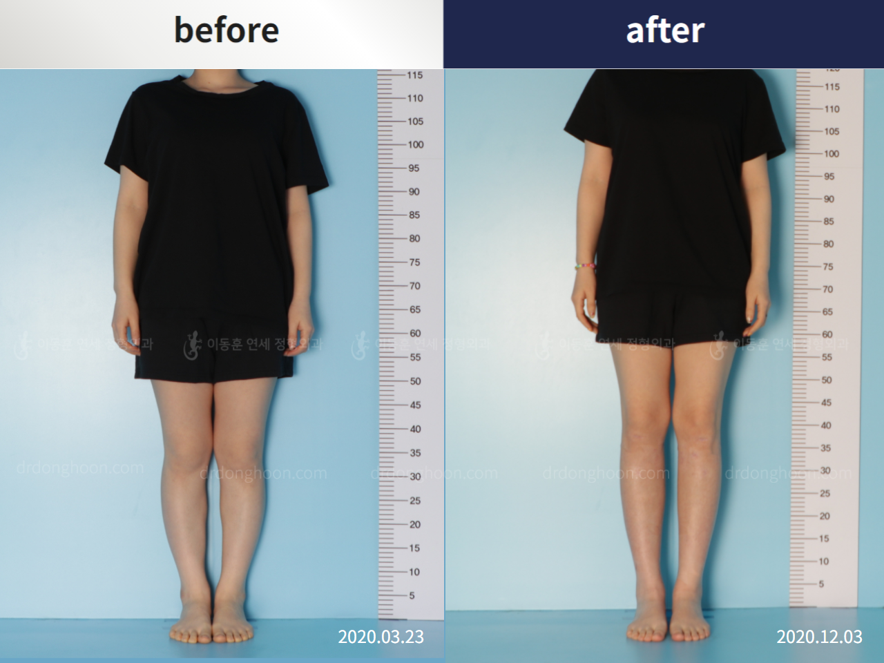 Before and after congenital condition, case 5456690, image 2, Dr. Donghoon institute (DALRI)