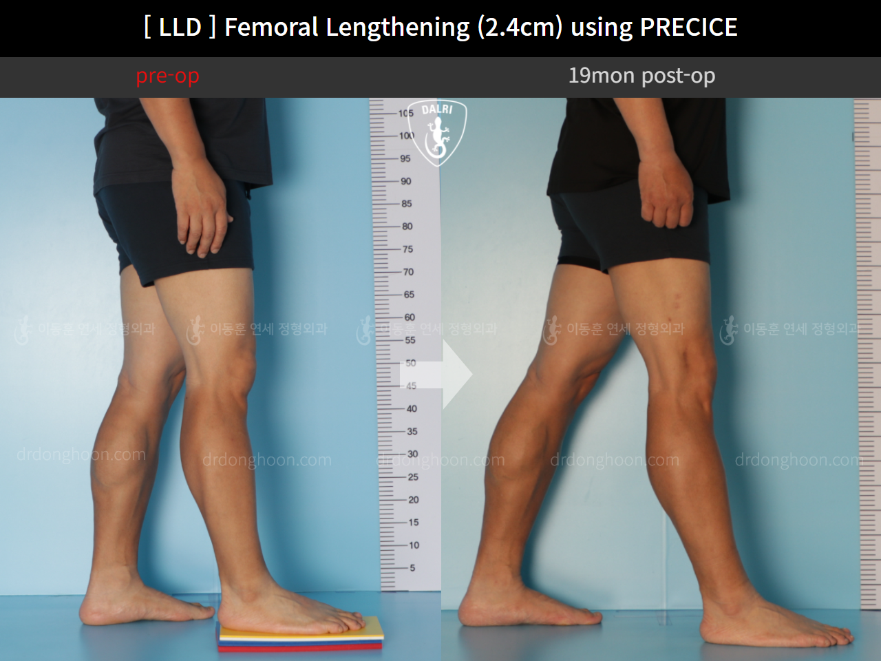 Before and after adult lld, case 10990486, image 7, Dr. Donghoon institute (DALRI)