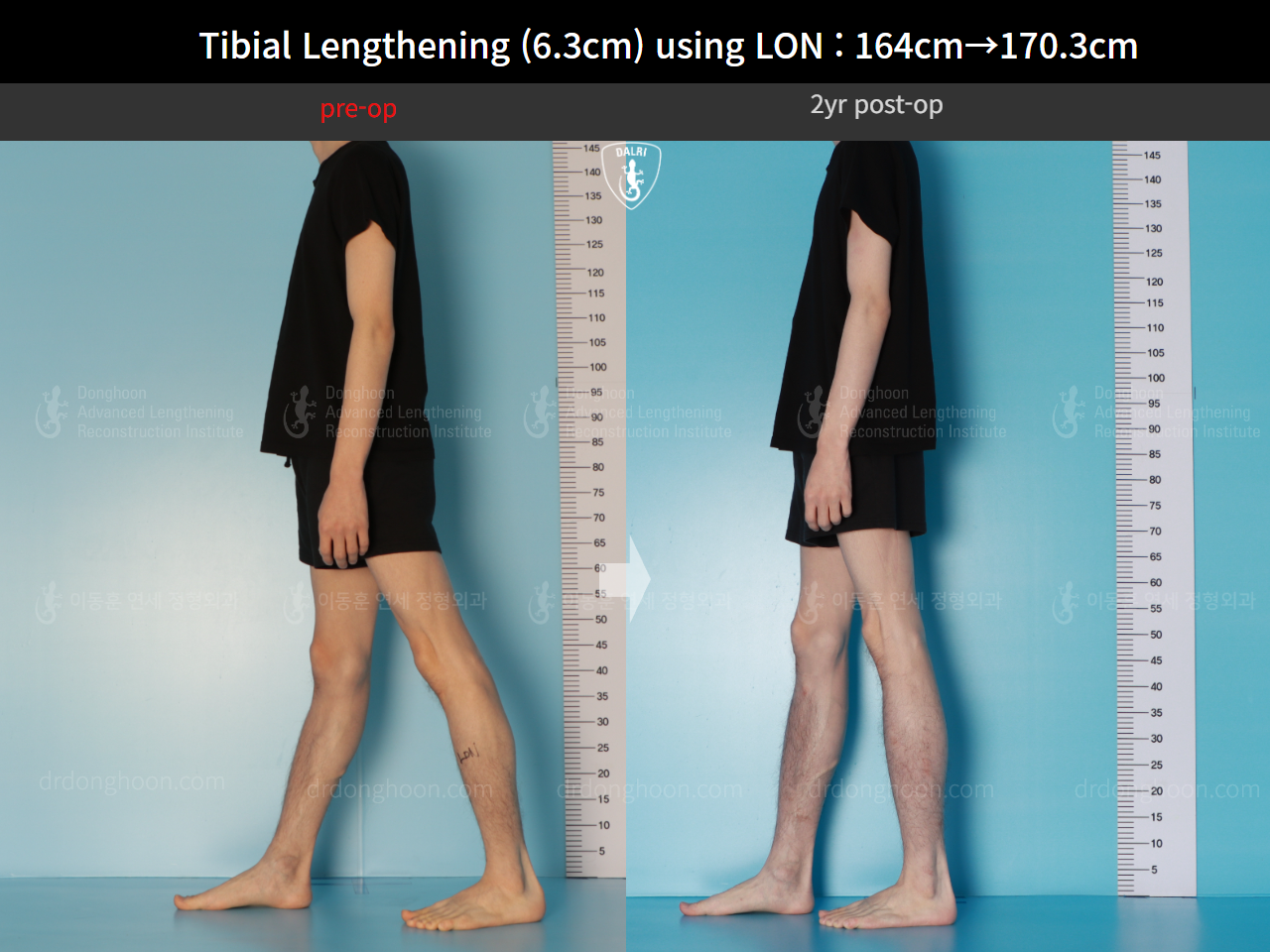 Before and after cll lon, case 16723608, image 8, Dr. Donghoon institute (DALRI)