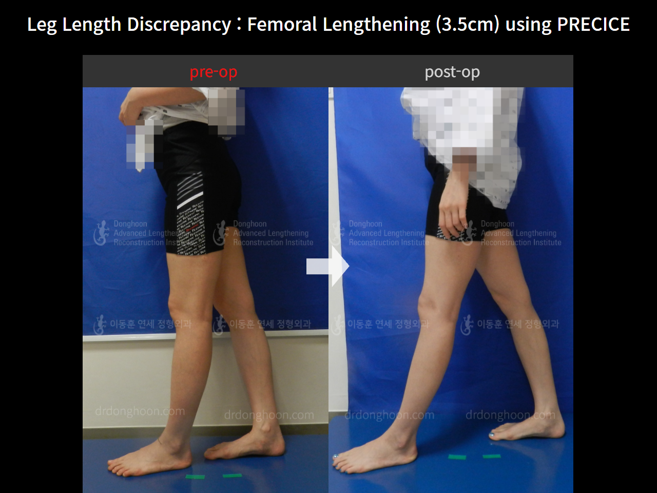 Before and after adult lld, case 4320329, image 3, Dr. Donghoon institute (DALRI)