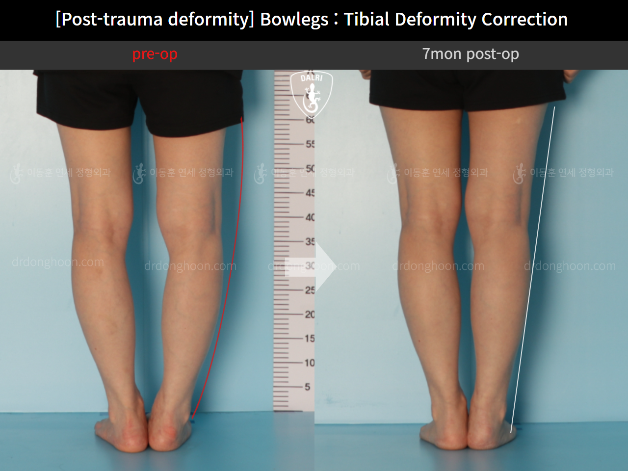 Before and after post-trauma deformity, case 10389267, image 4, Dr. Donghoon institute (DALRI)