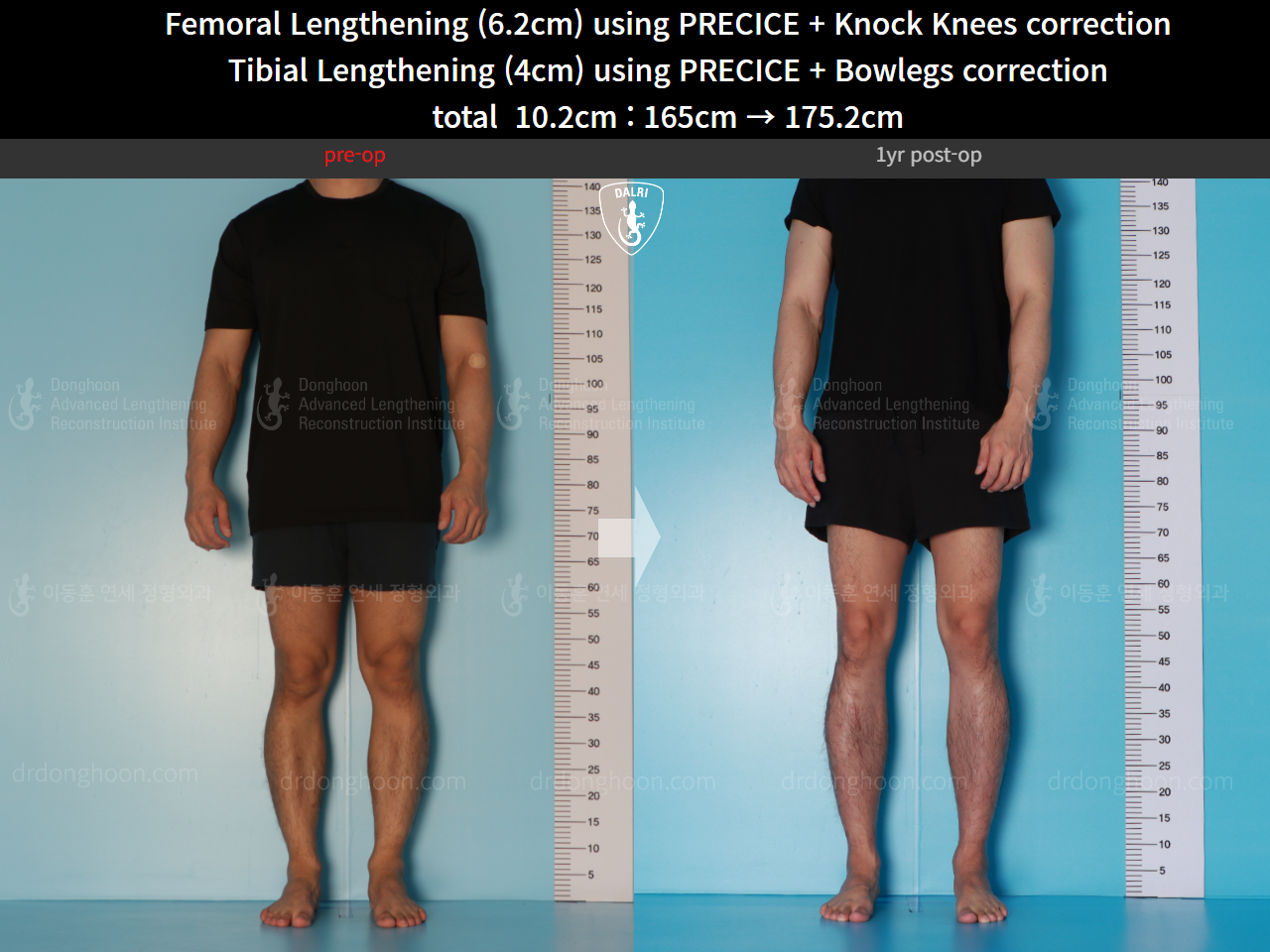 Before and after cll precice, case 15903274, image 3, Dr. Donghoon institute (DALRI)