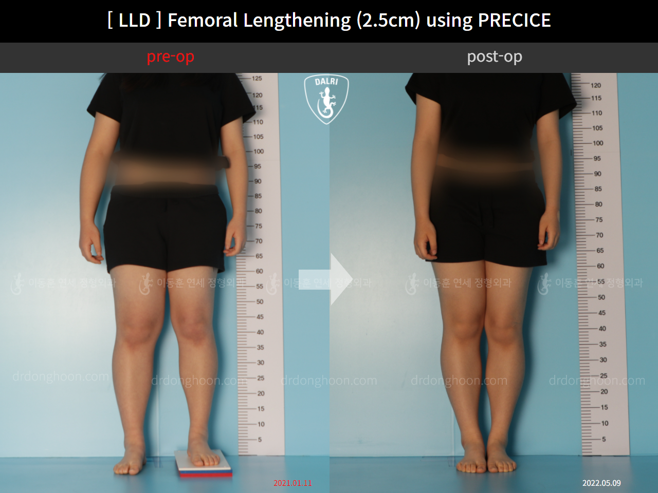 Before and after adult lld, case 11367647, image 1, Dr. Donghoon institute (DALRI)