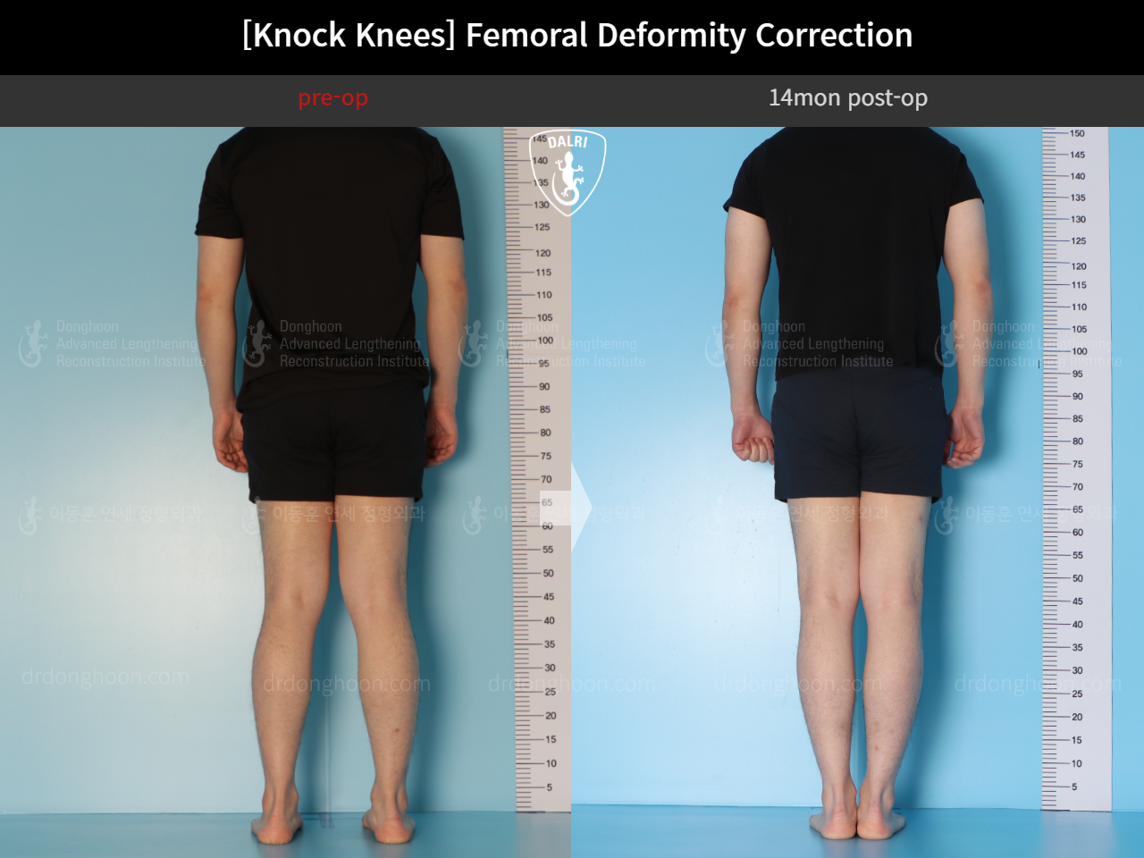 Before and after adult knock knees, case 15816319, image 6, Dr. Donghoon institute (DALRI)