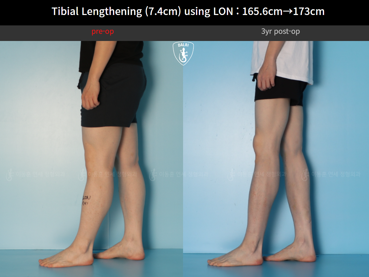 Before and after cll lon, case 125561518, image 9, Dr. Donghoon institute (DALRI)