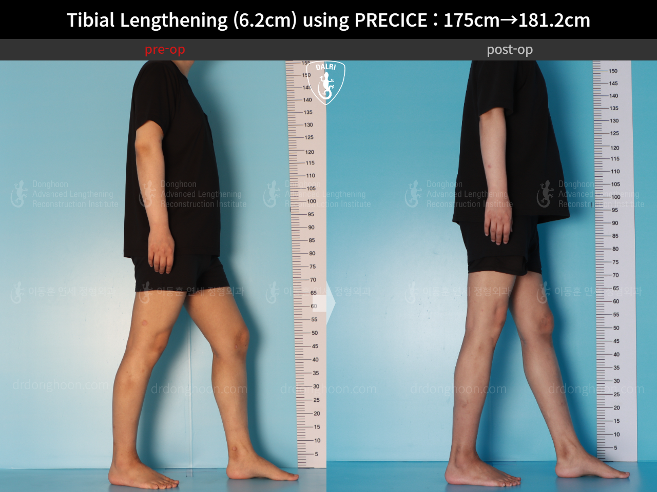 Before and after cll precice, case 16277428, image 8, Dr. Donghoon institute (DALRI)