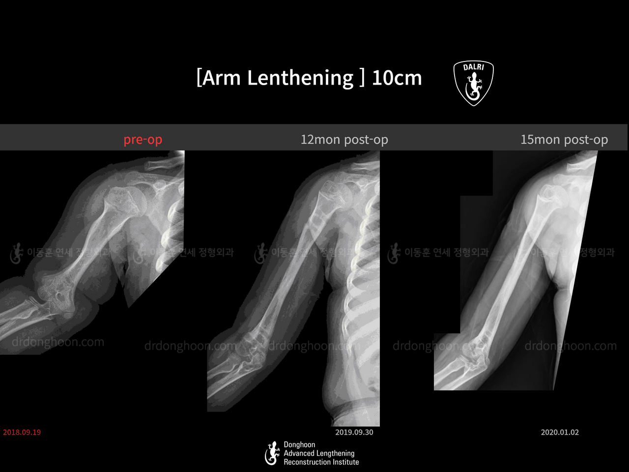 Before and after arm lengthening, case 13578638, image 4, Dr. Donghoon institute (DALRI)
