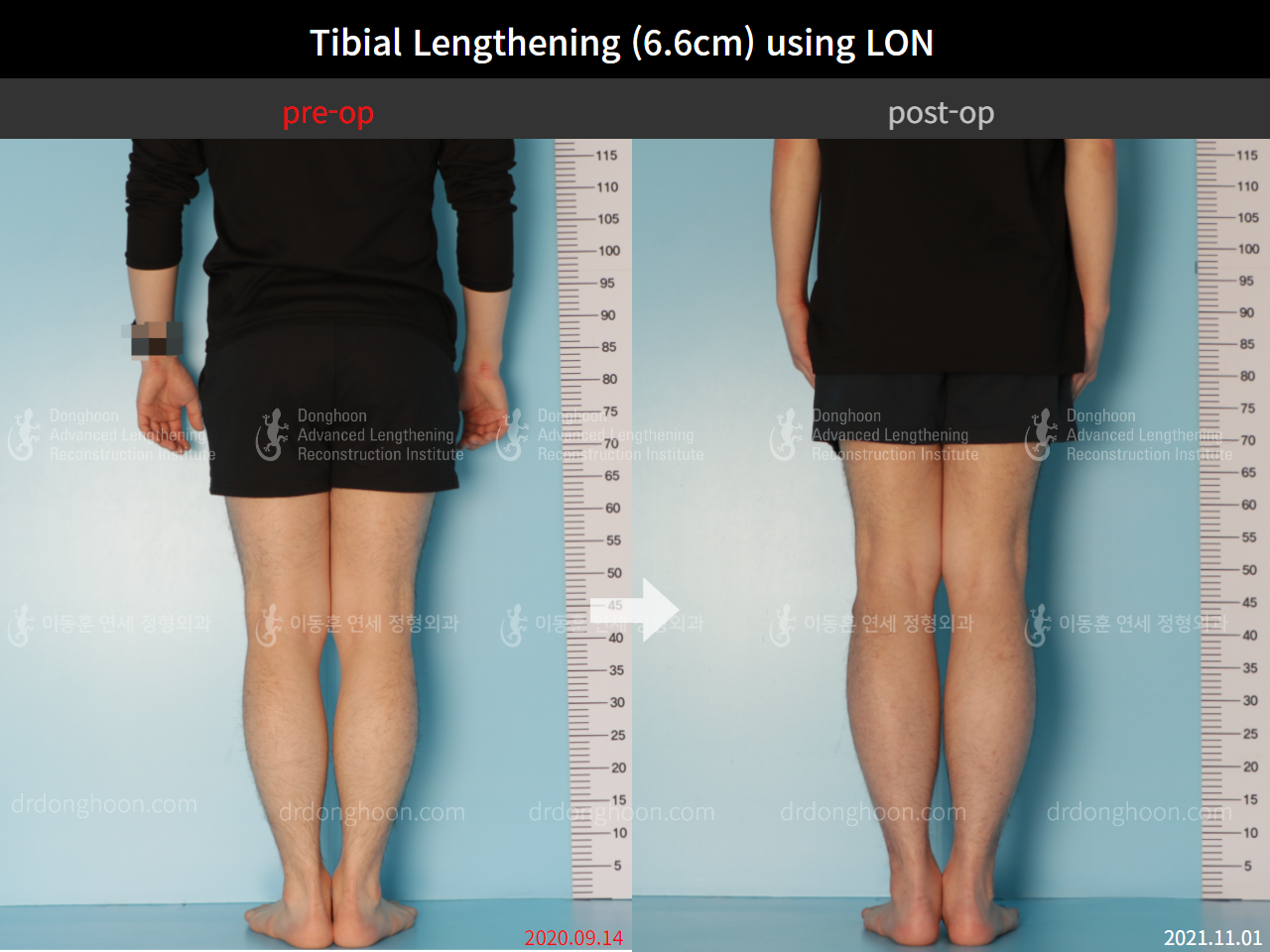 Before and after cll lon, case 8764128, image 6, Dr. Donghoon institute (DALRI)