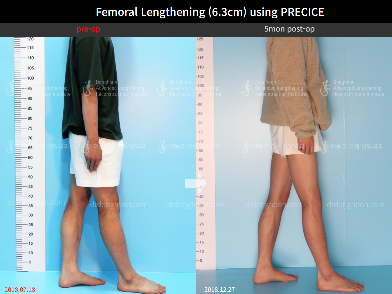 Before and after cll precice, case 4323398, image 2, Dr. Donghoon institute (DALRI)