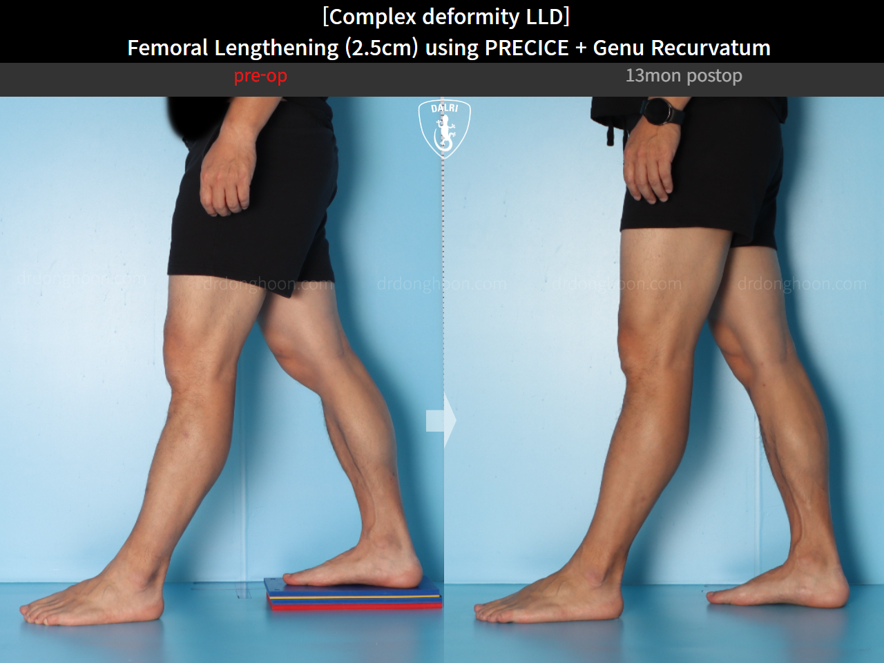 Before and after genu recurvatum, case 16854701, image 10, Dr. Donghoon institute (DALRI)