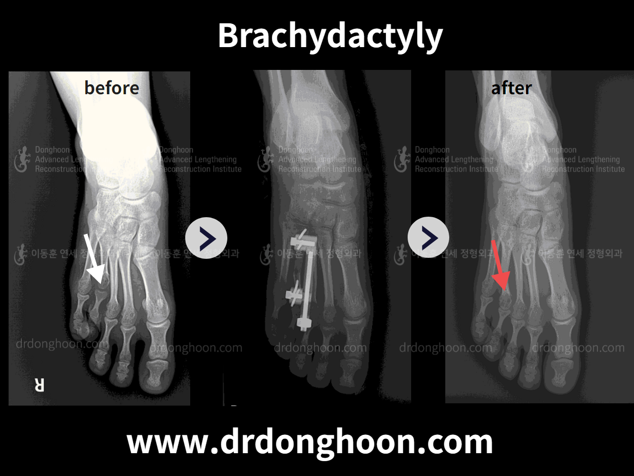Before and after brachymetatarsia, case 4249058, image 2, Dr. Donghoon institute (DALRI)