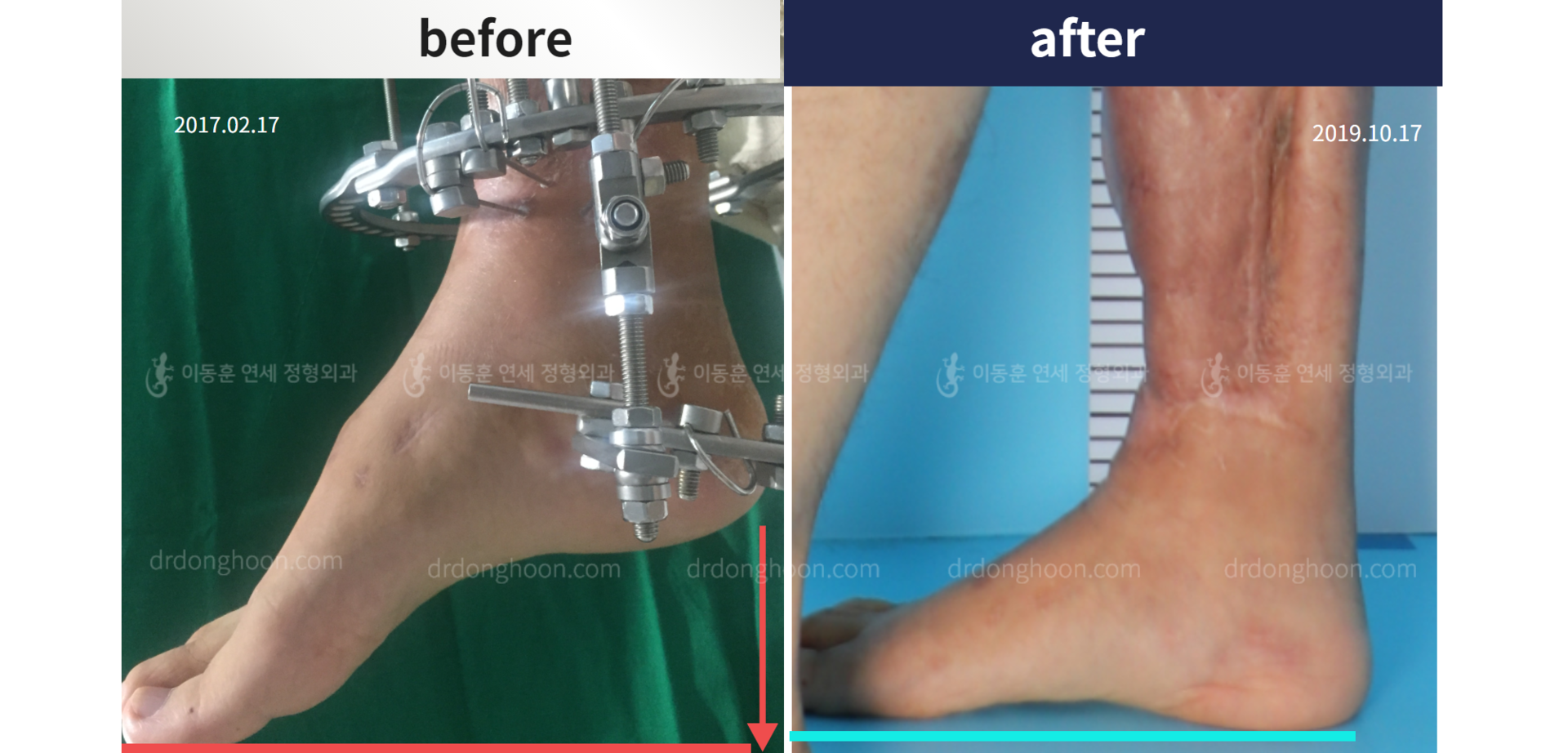 Before and after re-operation for cll, case 5200498, image 7, Dr. Donghoon institute (DALRI)