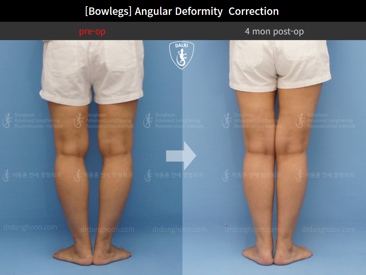 Before and after adult bowlegs, case 9289009, image 8, Dr. Donghoon institute (DALRI)