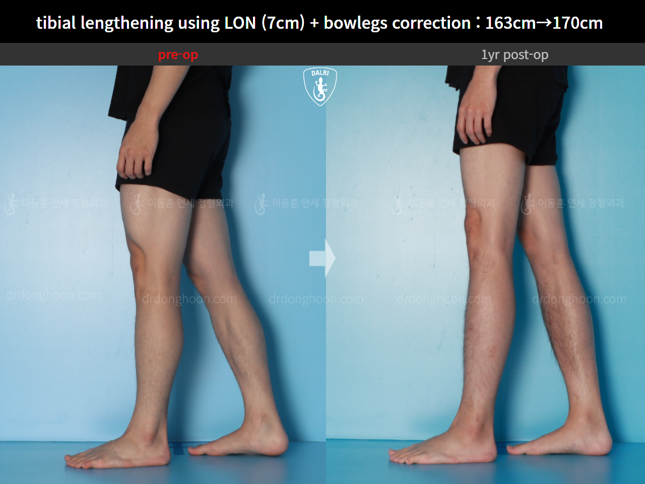 Before and after cll + deformity correction, case 16131910, image 11, Dr. Donghoon institute (DALRI)