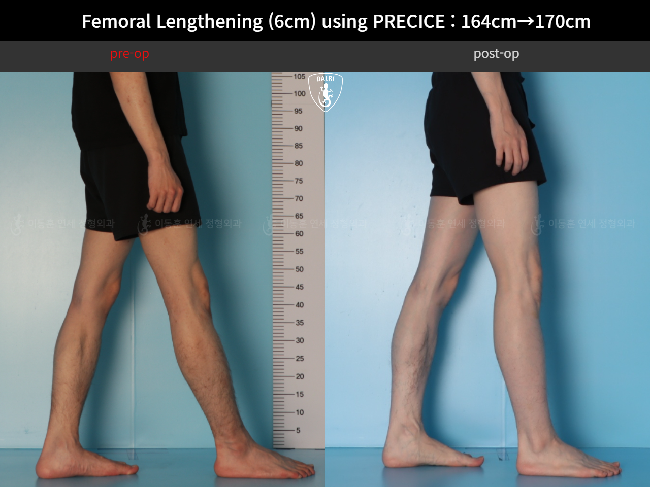Before and after cll precice, case 33570290, image 9, Dr. Donghoon institute (DALRI)