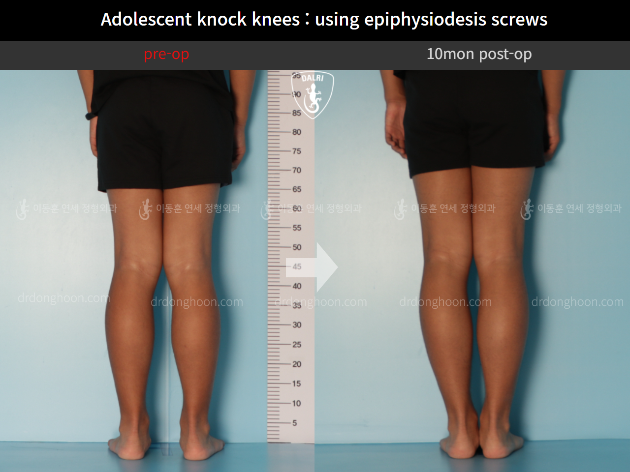 Before and after paediatric & adolescent knock knees, case 11511975, image 4, Dr. Donghoon institute (DALRI)