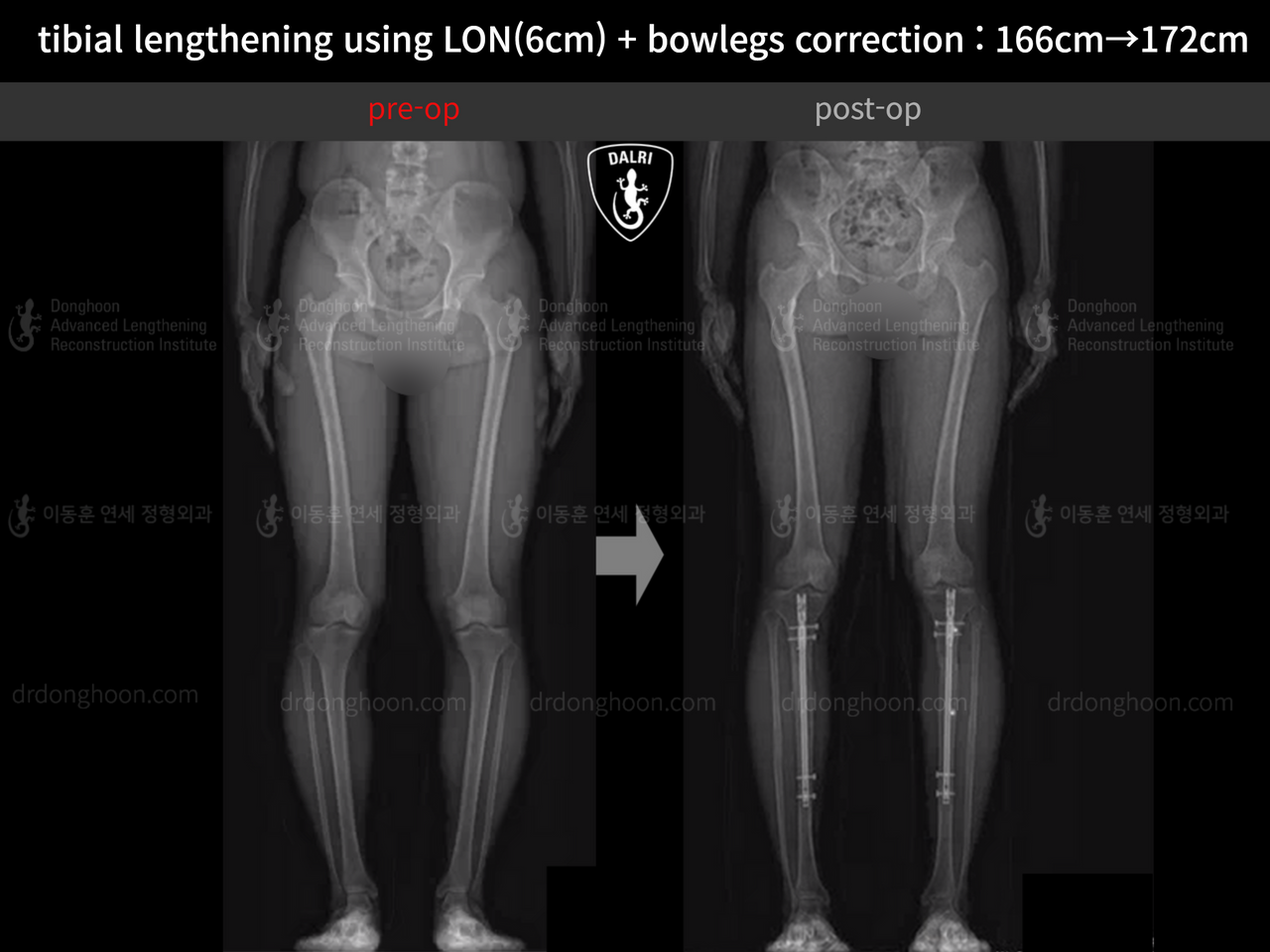 Before and after cll + deformity correction, case 13915297, image 2, Dr. Donghoon institute (DALRI)