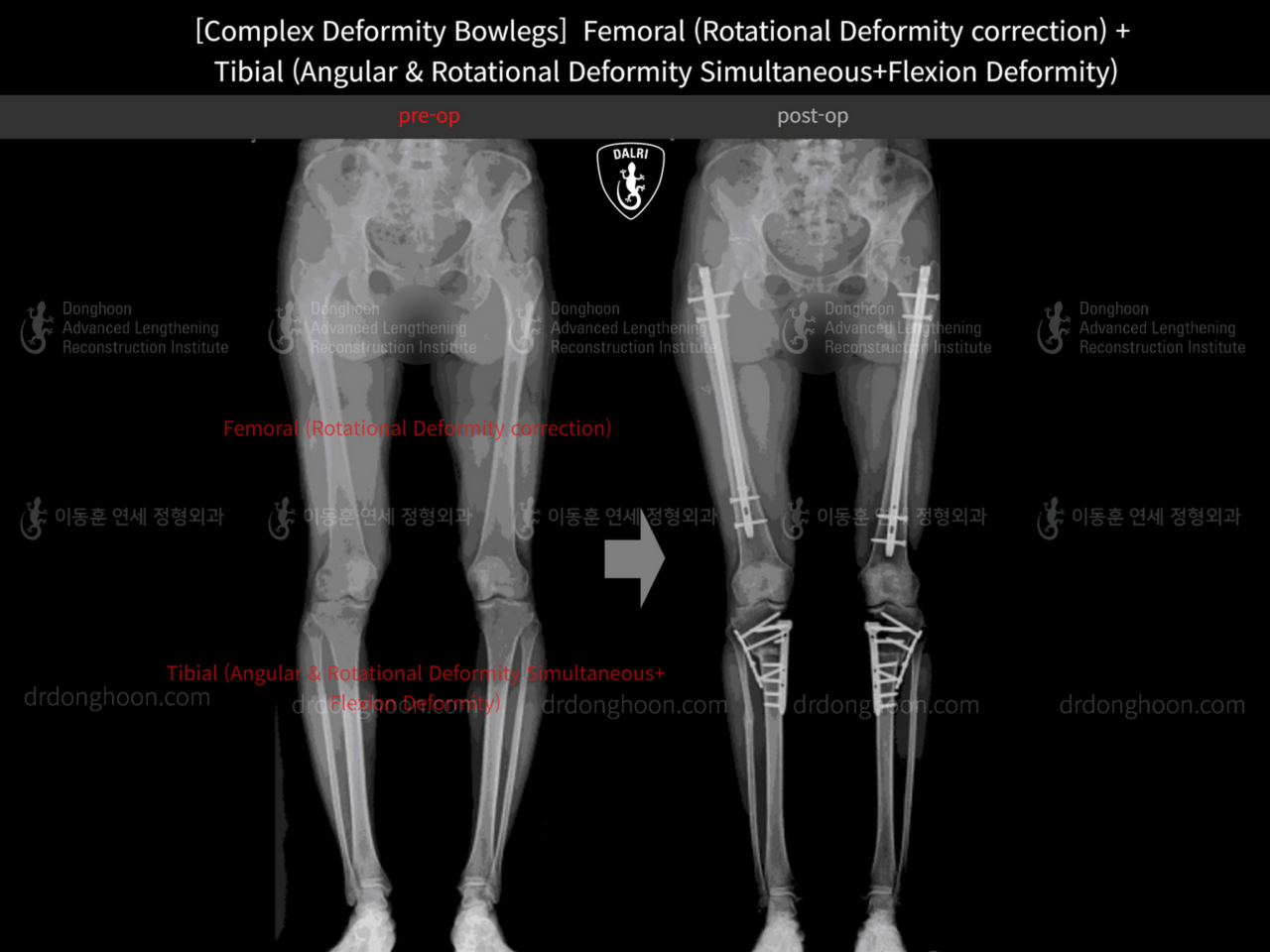 Before and after complex deformity, case 13185732, image 3, Dr. Donghoon institute (DALRI)