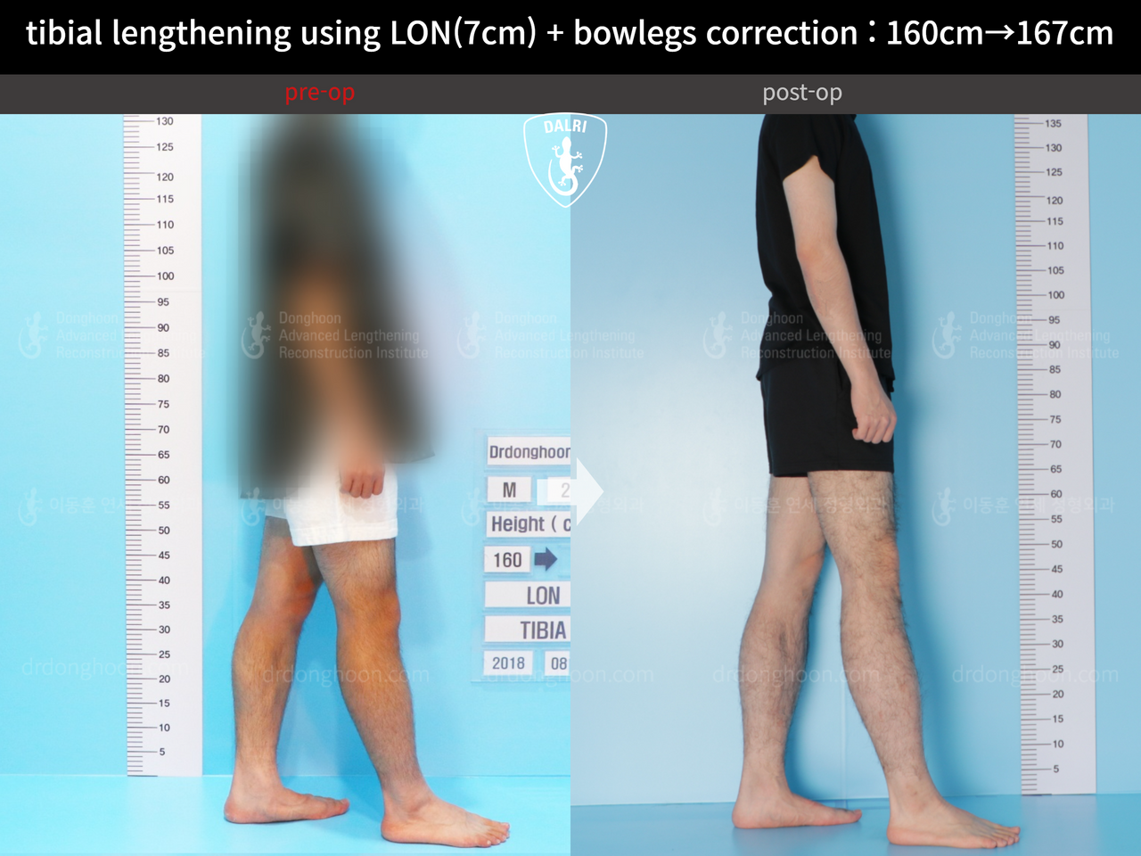 Before and after cll + deformity correction, case 13241722, image 4, Dr. Donghoon institute (DALRI)