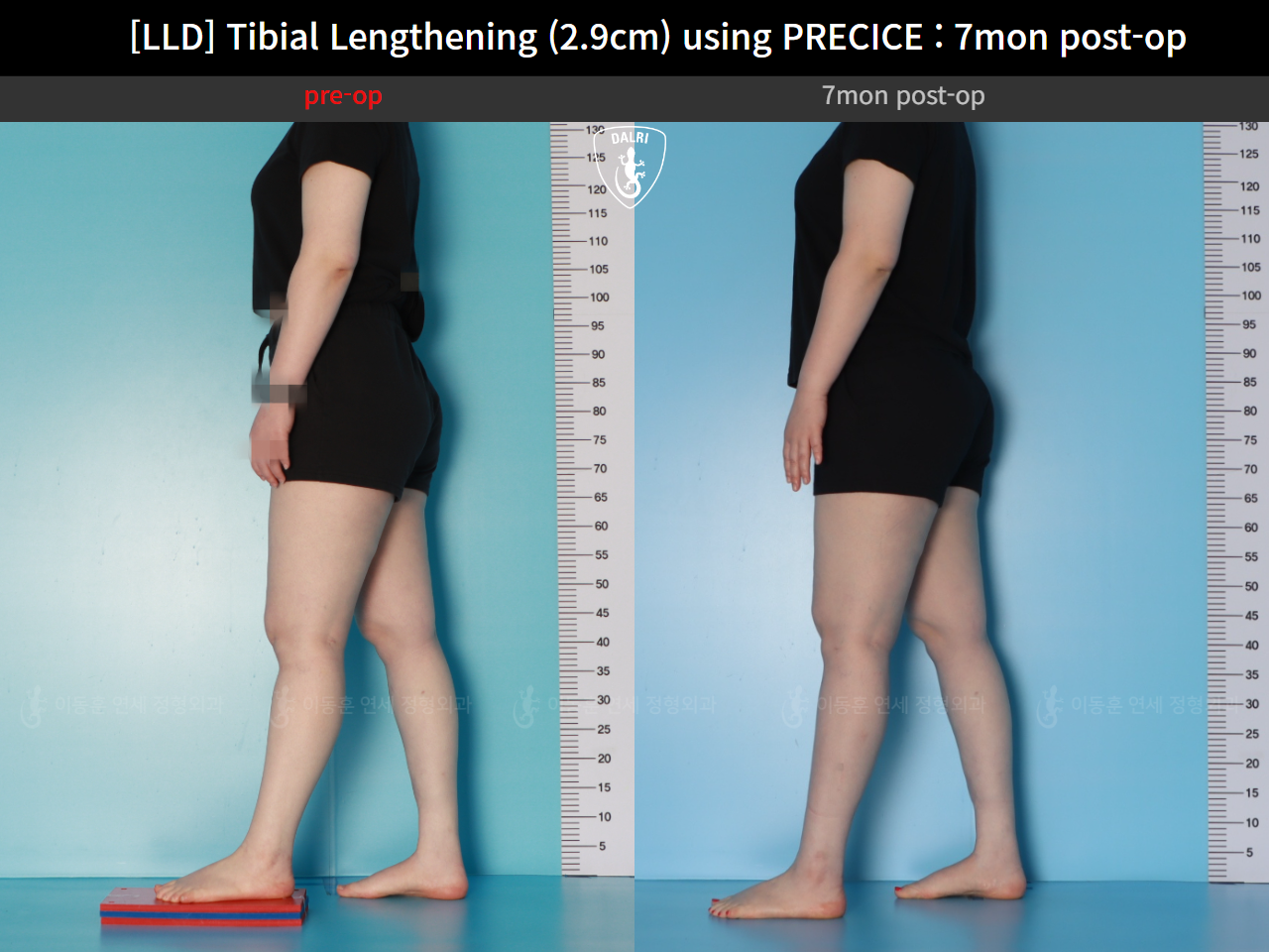 Before and after adult lld, case 62389039, image 3, Dr. Donghoon institute (DALRI)