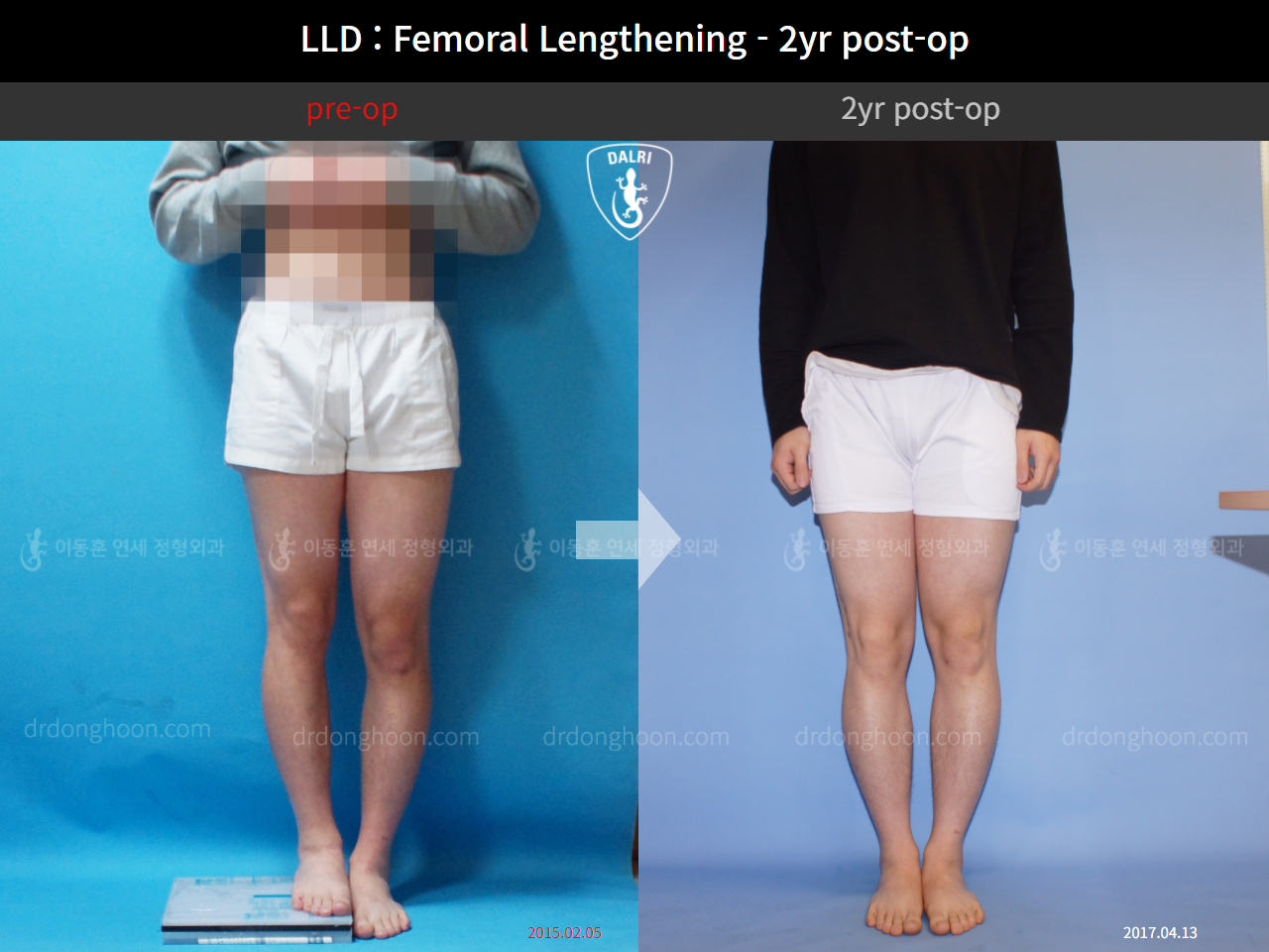 Before and after adult lld, case 4320322, image 1, Dr. Donghoon institute (DALRI)