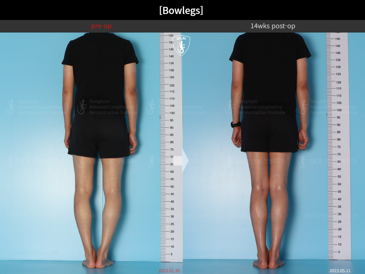 Before and after adult bowlegs, case 15512423, image 4, Dr. Donghoon institute (DALRI)