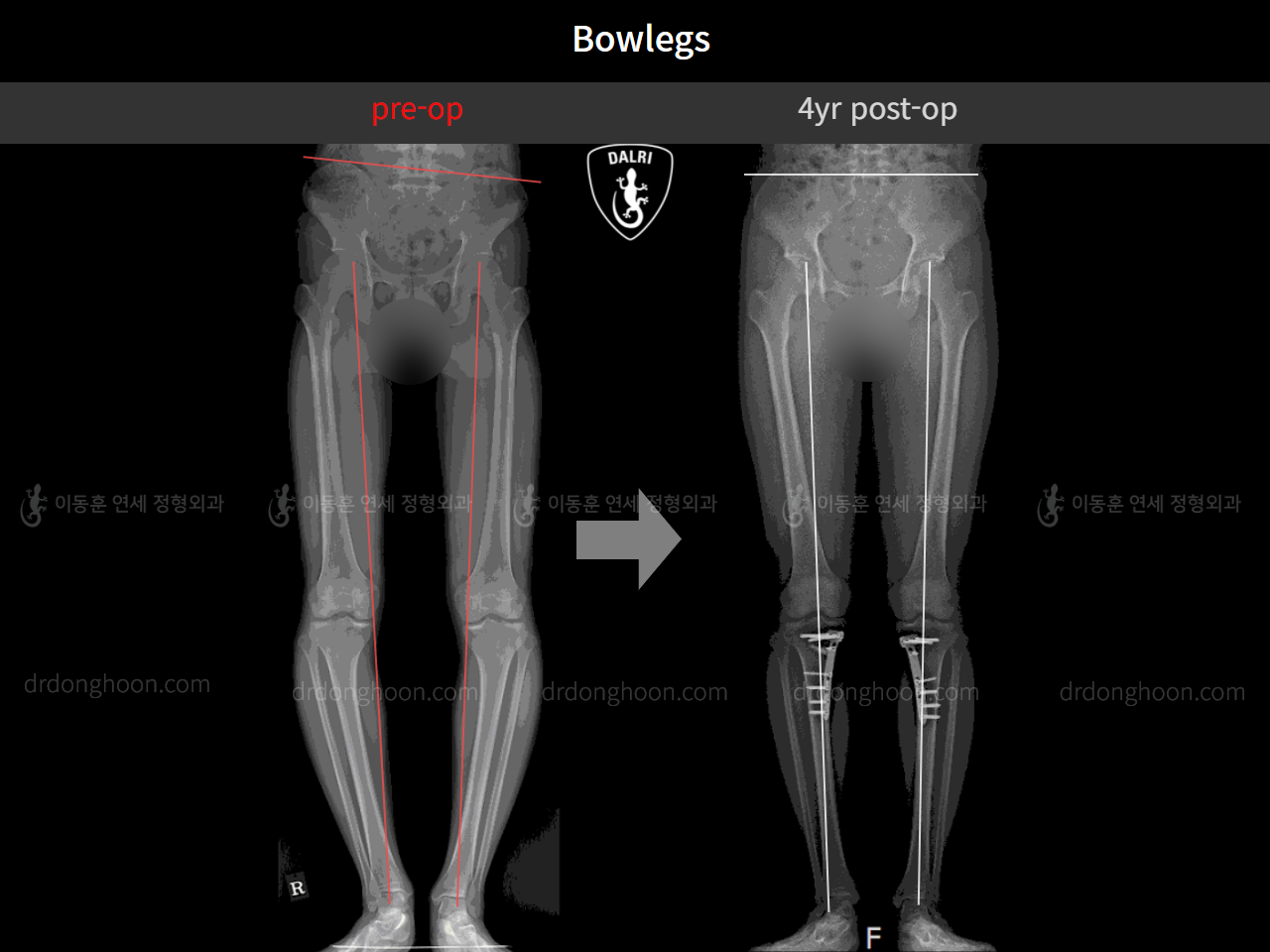 Before and after adult bowlegs, case 4311360, image 10, Dr. Donghoon institute (DALRI)
